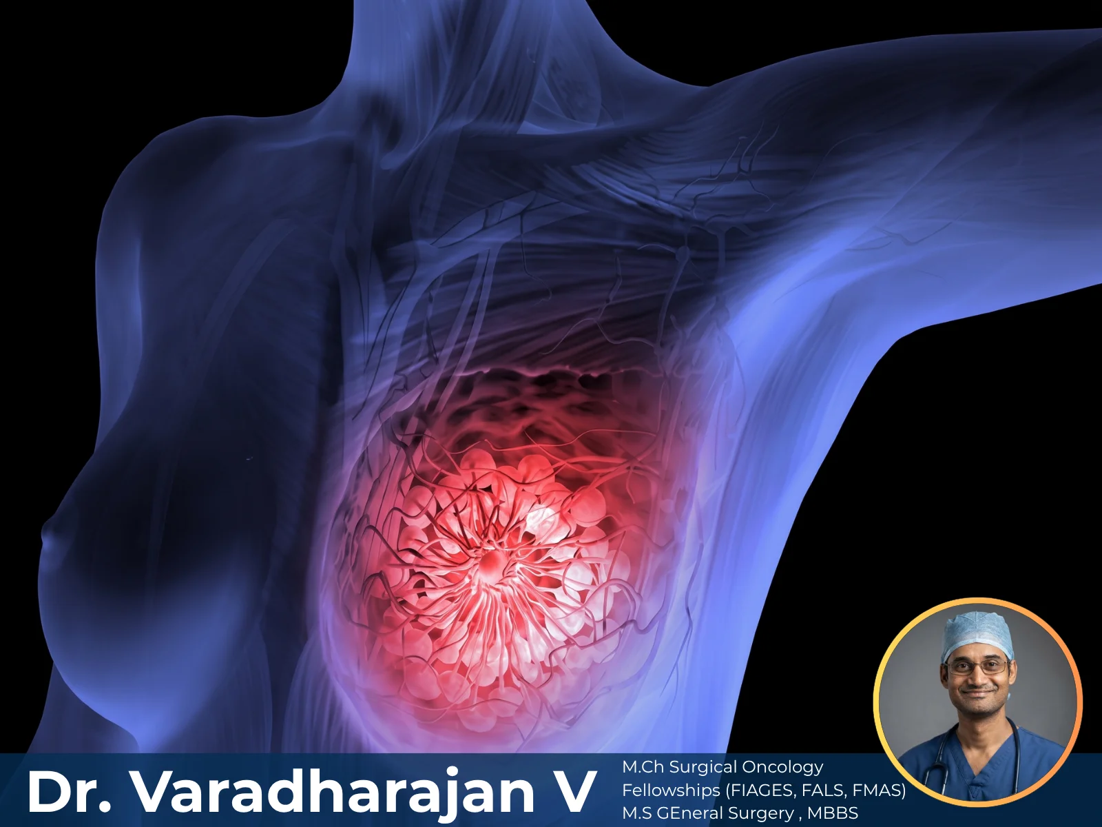 Breast Cancer Surgeries